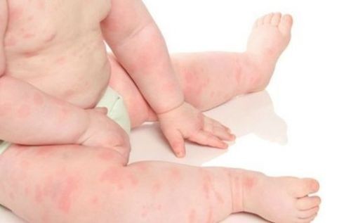 Mày đay (Nổi mẩn ngứa): Nhận biết, xử trí và phòng ngừa tái phát Mày đay (Nổi mẩn ngứa): Nhận biết, xử trí và phòng ngừa tái phát